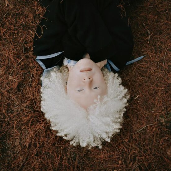 Understanding albinism