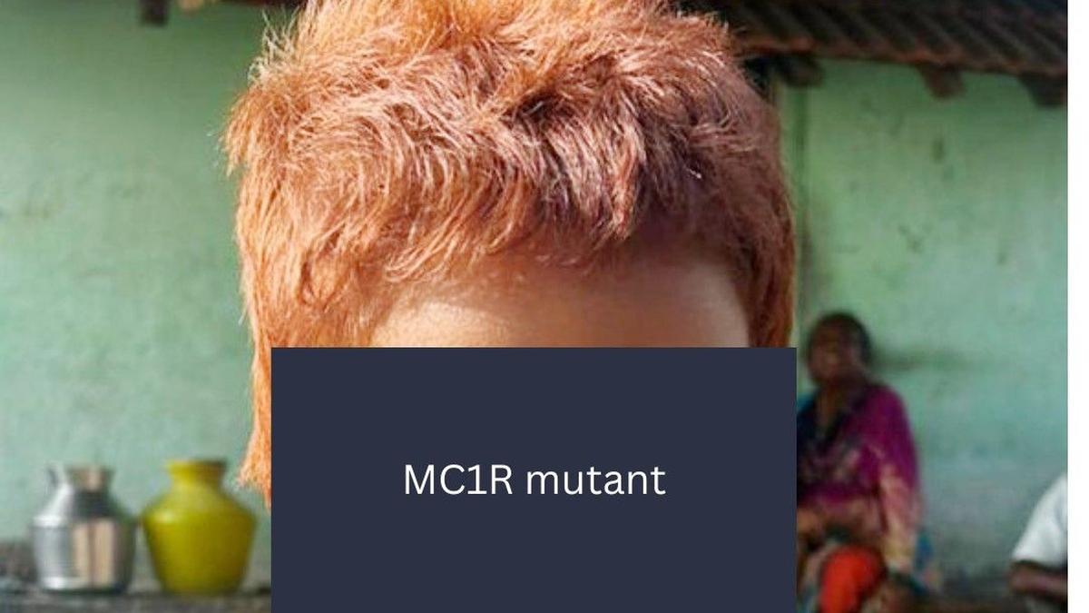 CCMB scientists identify rare gene behind Indian girl’s red hair