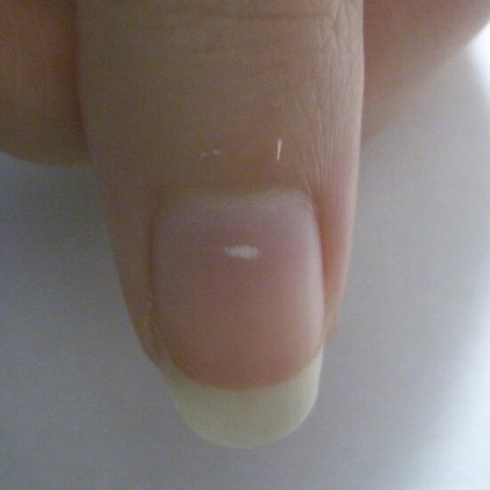 What changes in your nails may reveal about nutrition, trauma and chronic disease