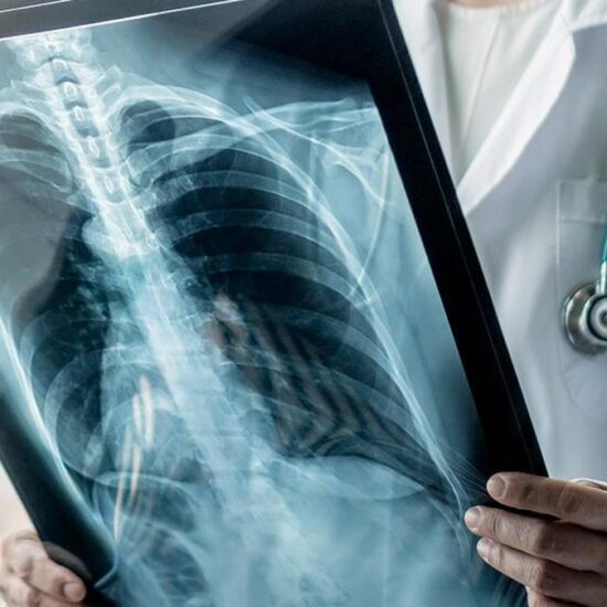 Can lung cancer be prevented using a drug?